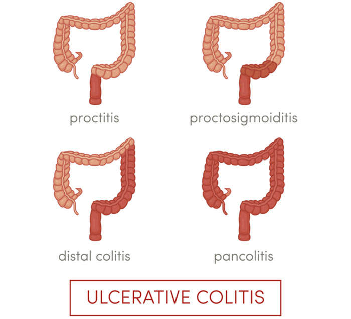 Ucerative colitis treatment, ulcer, ulcer treatment
