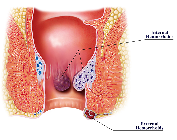 hemorrhoids treatment, hemorrhoids cure