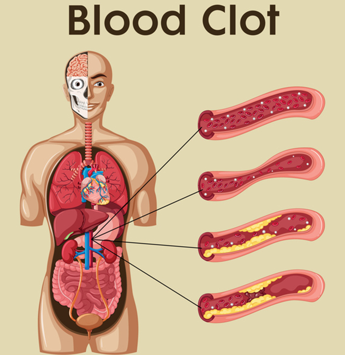 blood clot treatment, blood clot treatments