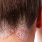scalp plaque psoriasis, scalp plaque psoriasis treatment, scalp psoriasis treatment