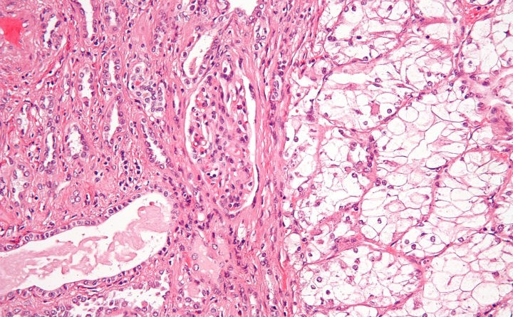 metastatic renal cell carcinoma treatment, renal cell carcinoma diagnosis, metastatic renal cell carcinoma, metastatic renal cell carcinoma treatments, What is Renal Cell Carcinoma Cancer?, metastatic renal carcinoma treatments, metastatic renal cell carcinoma diagnosis, renal cell carcinoma treatment, renal cell carcinoma, alternative kidney cancer treatment, advanced kidney cancer treatments, kidney cancer survival rates, treatment advanced kidney cancer, metastatic kidney cancer treatments, treatment for metastatic kidney cancer