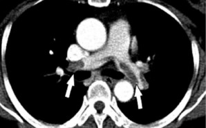 treatment pulmonary embolism, pulmonary embolism treatment, pulmonary embolism treatments, treatments for pulmonary embolism, treatment for pulmonary embolism, pulmonary embolism info