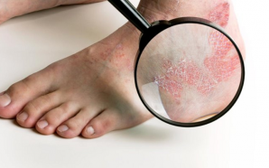 Eczema Complications and Prevention