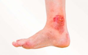 Atopic Dermatitis Eczema