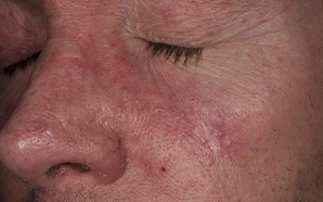 What Causes Seborrheic Dermatitis?