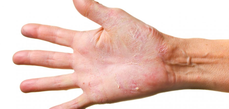 chronic eczema treatment