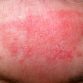 dupixent dupilumab eczema treatments