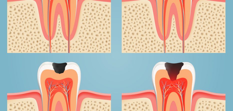 Tooth Abscess Treatment