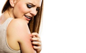 Severe Eczema Treatment