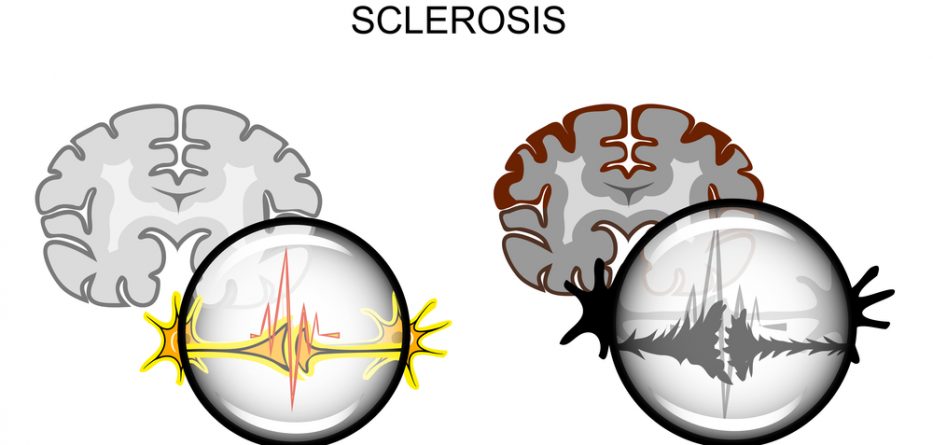 copaxone multiple sclerosis treatments