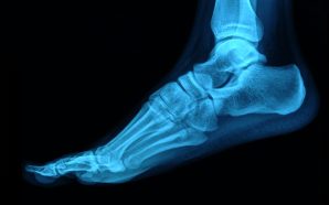 treatment of rheumatoid arthritis foot pain