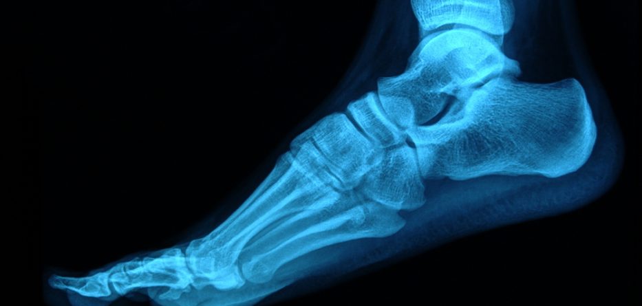 treatment of rheumatoid arthritis foot pain