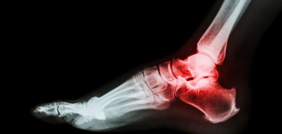 treatment for rheumatoid arthritis ankle pain