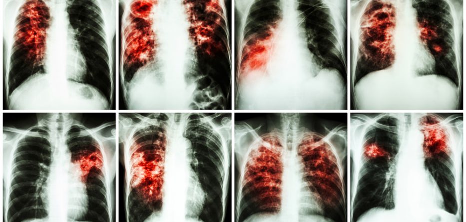 pulmonary fibrosis management