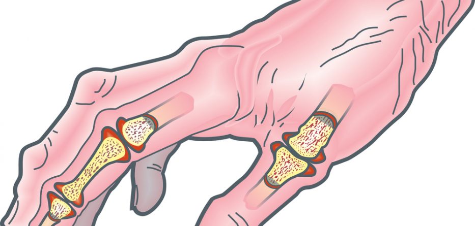 rheumatoid arthritis finger pain treatment