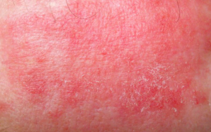 What Causes Widespread Skin Rashes?