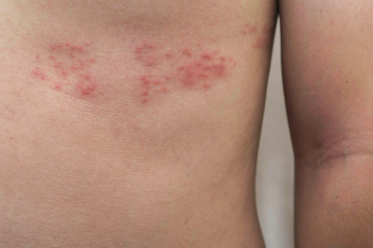 Dose Herpes increase risk of getting HIV?
