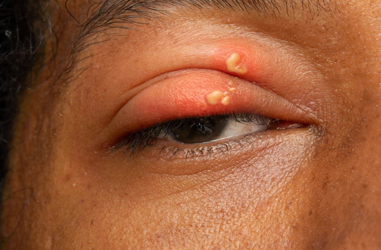 Herpes & Eye Health